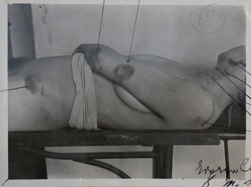 Ripresa di profilo del busto di Vittoria Nicolotti con in evidenza il morso sul braccio