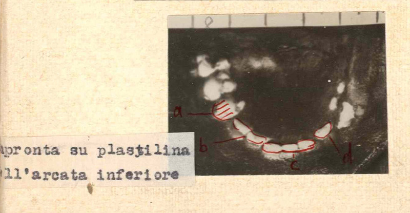 Impronta su plastilina dell’arcata inferiore della dentatura di Rosa Vercesi