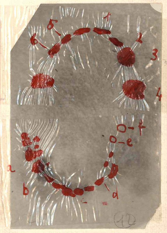Comparazione per sovrapposizione tra le impronte della dentatura di Rosa Vercesi e quelle del morso sul braccio di Vittoria Nicolotti