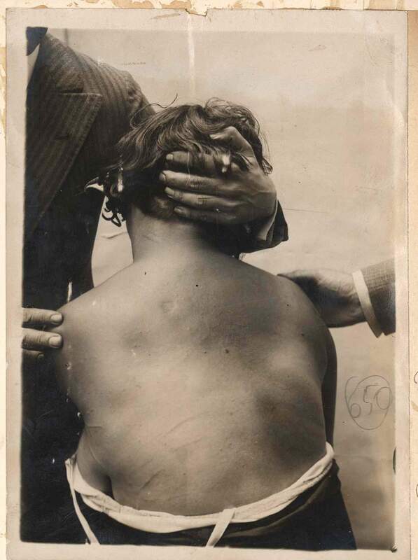 I graffi sulla schiena e sul collo di Rosa Vercesi, sospettata dell’omicidio di Vittoria Nicolotti 