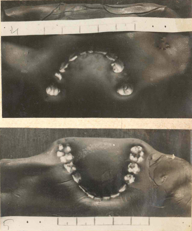 Riproduzione fotografica delle impronte su plastilina della dentatura di Rosa Vercesi