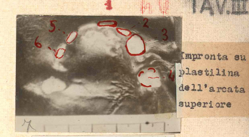 Impronta su plastilina dell’arcata superiore della dentatura di Rosa Vercesi