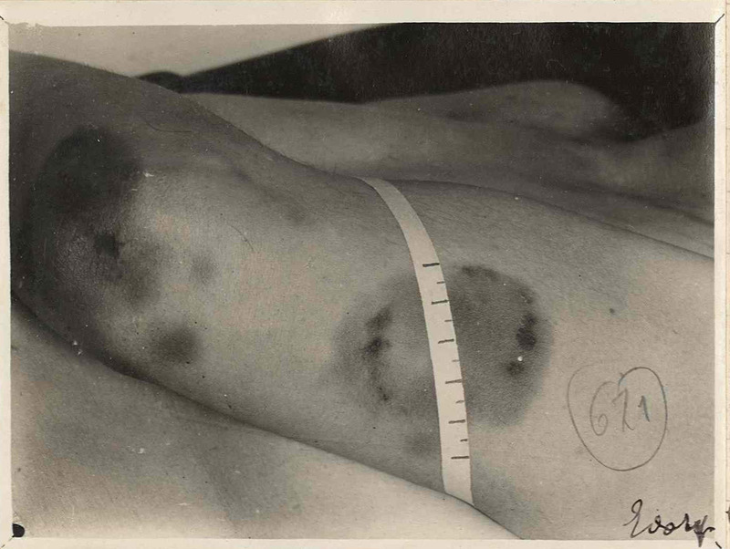 Dettaglio del morso sul braccio sinistro di Vittoria Nicolotti 