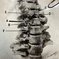 Le vertebre di Vincenzina Virando con l'indicazione dei segni dei proiettili